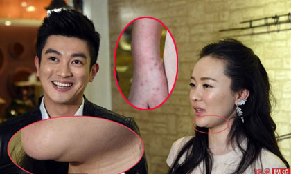 Hoắc Tư Yến lộ cằm ngấn mỡ và nốt đỏ chi chít ở tay